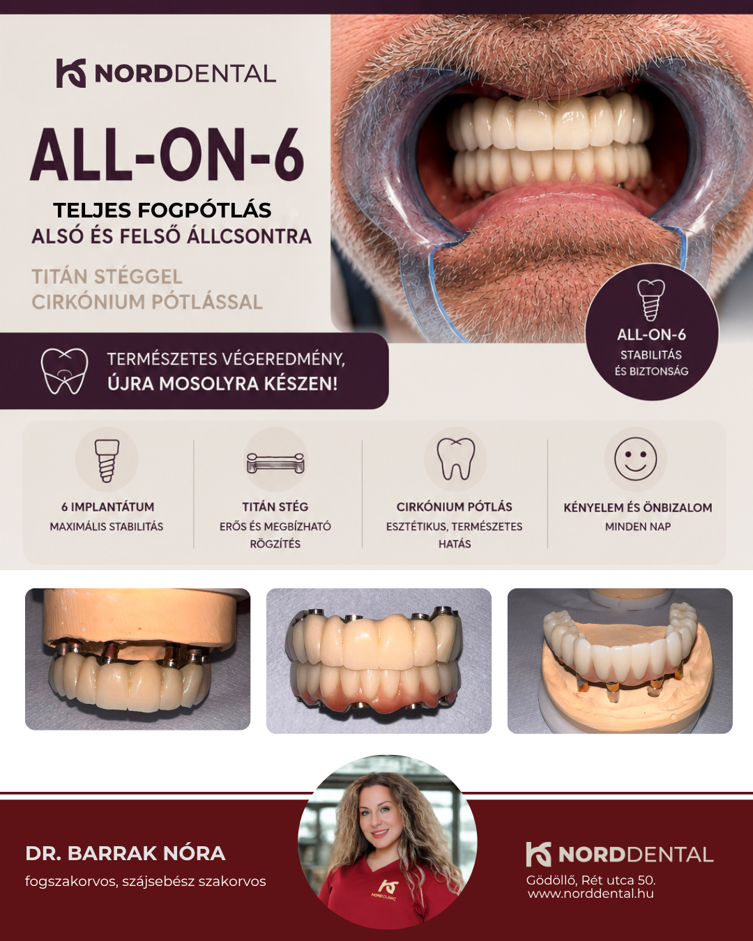 All-on-6 és All-on-4 Nord Dental esetleírás