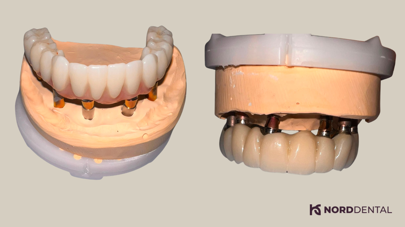 All-on-6 fogimplantáció Nord Dental fogsor