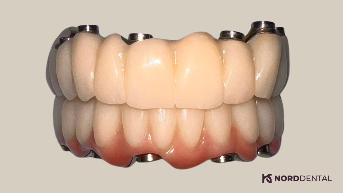 All-on-6 fogimplantáció Nord Dental teljes fogsor
