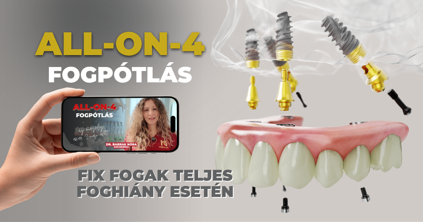 all-on-4 és all-on-6 fogpótlás cover kép